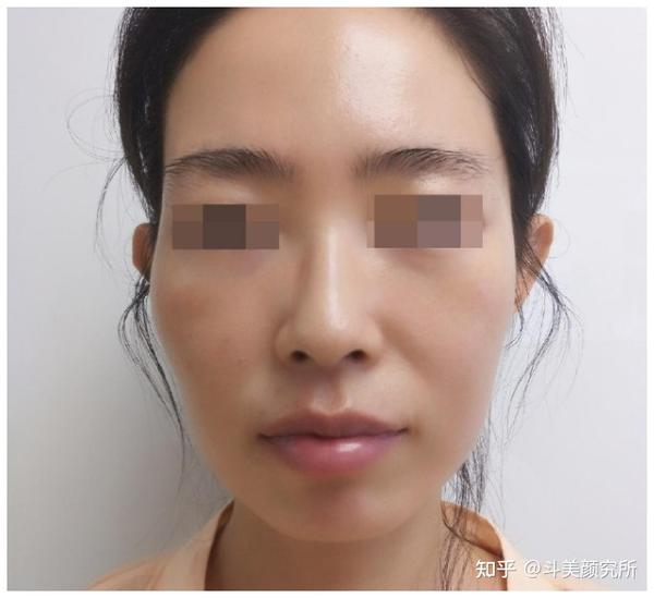 面颊凹陷的原因是什么？如何才能有效改善 - 知乎