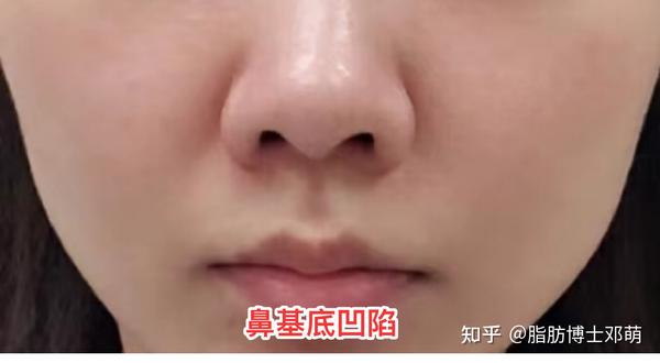 嘴凸,显老,还土气?赶紧救救你的鼻基底凹陷 - 知乎