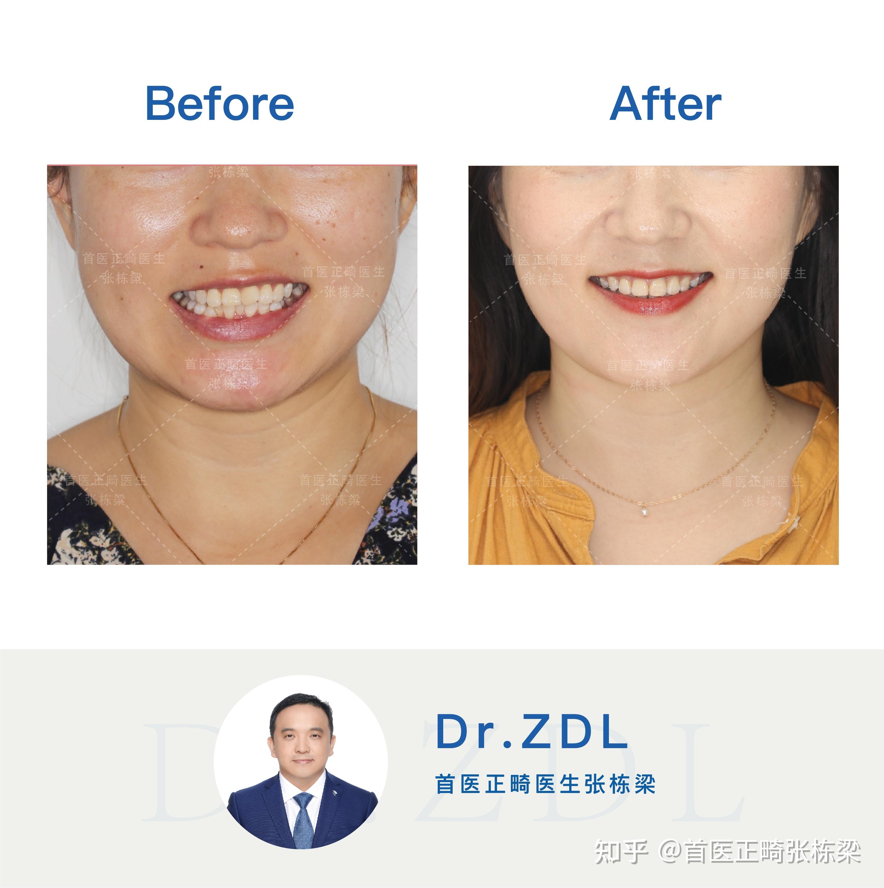 正畸可以提高笑线吗？ - 知乎