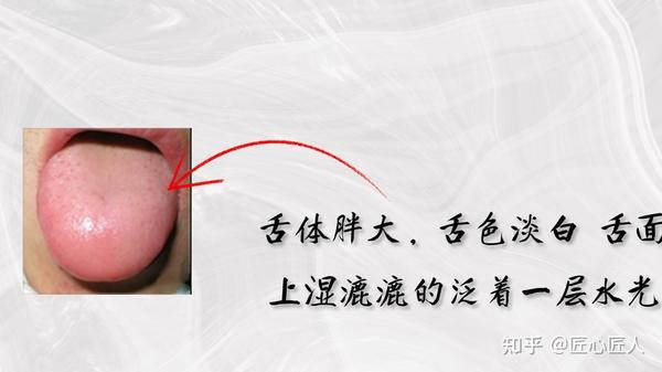 裂纹舌、齿痕舌、胖大舌分别代表了什么? - 知乎