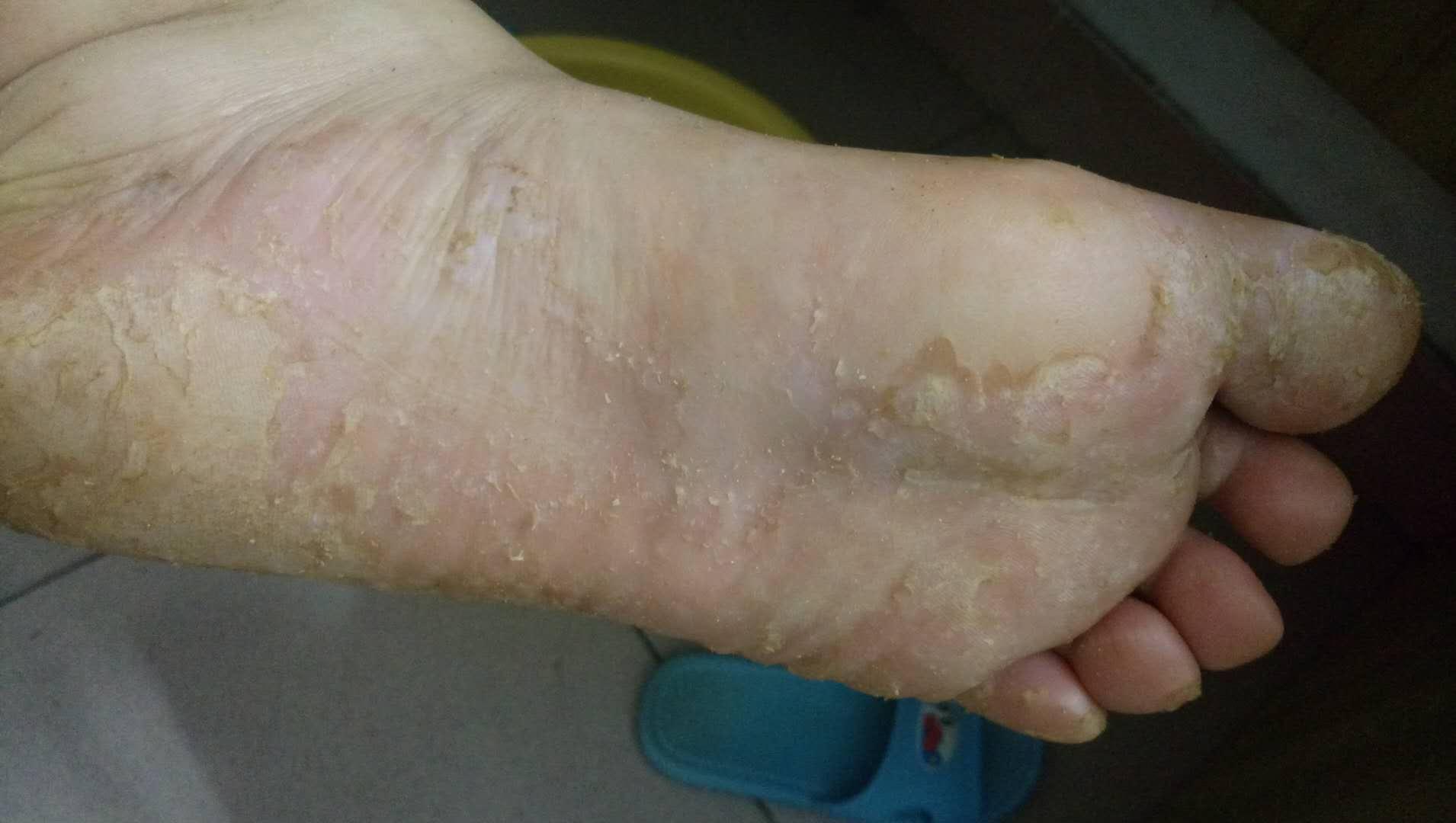 什么是脚气,怎么判断自己有没有脚气? - 知乎