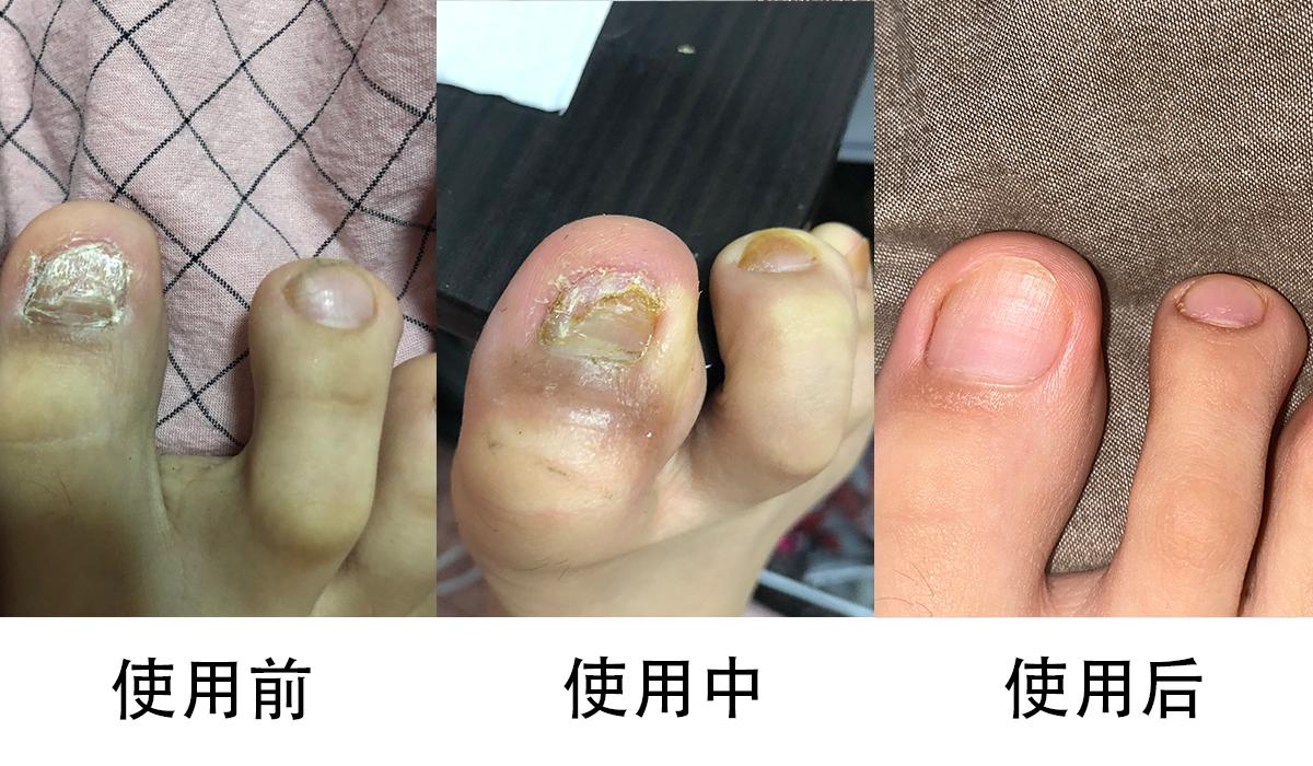 灰指甲严重到甲萎缩根除案例分享