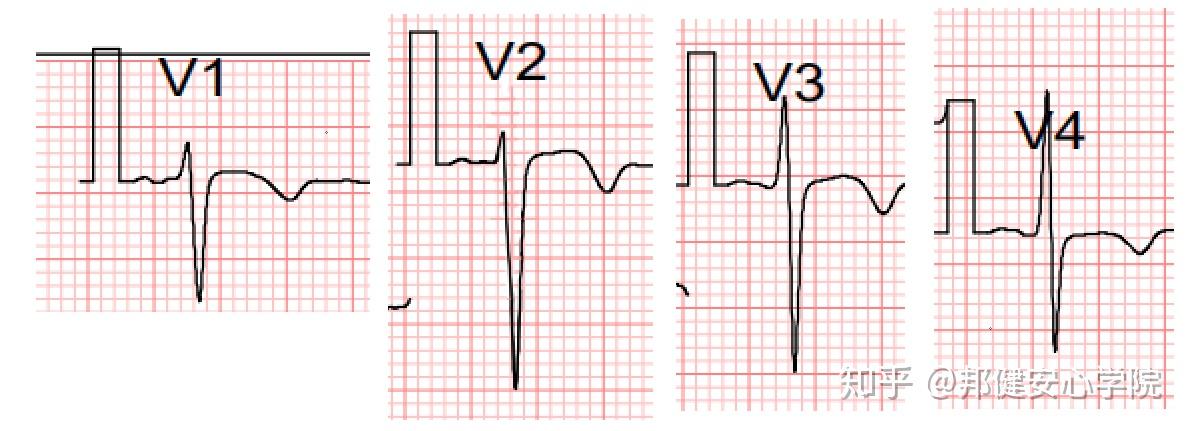 胸导联波形图片