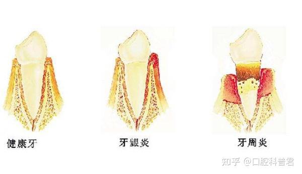 牙周炎一定要拔牙吗？一起来看看牙医怎么说 - 知乎