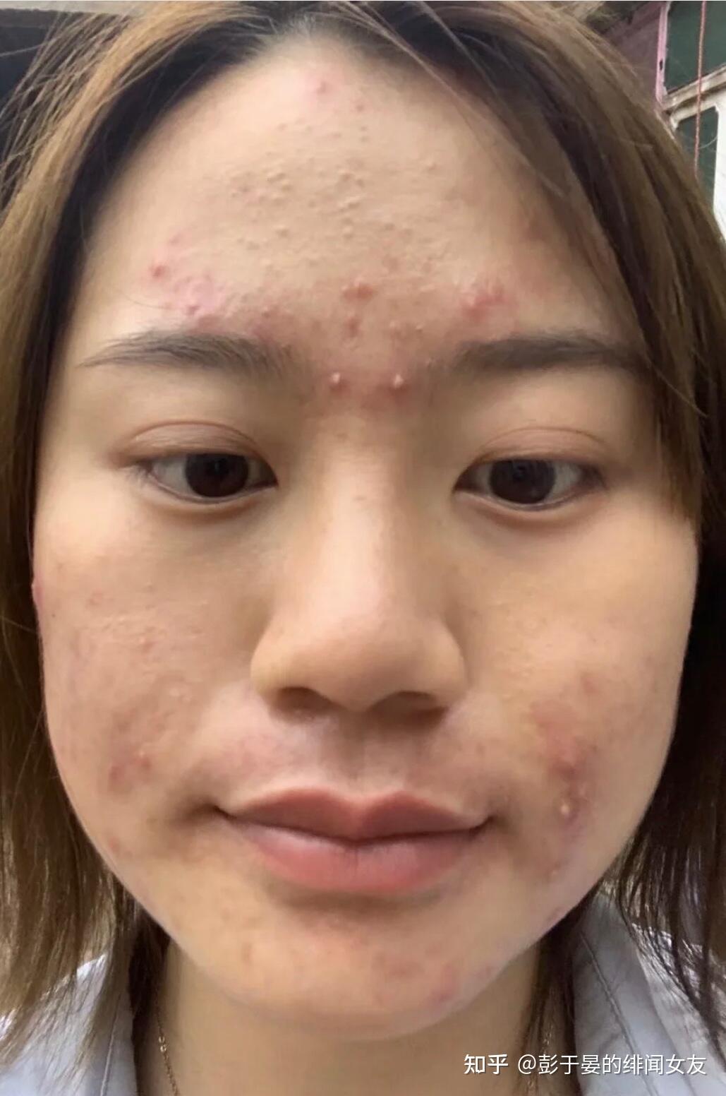 有人会喜欢长痘痘的女生嘛? - 知乎