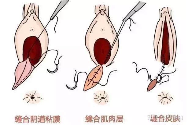 女性手术危害图片