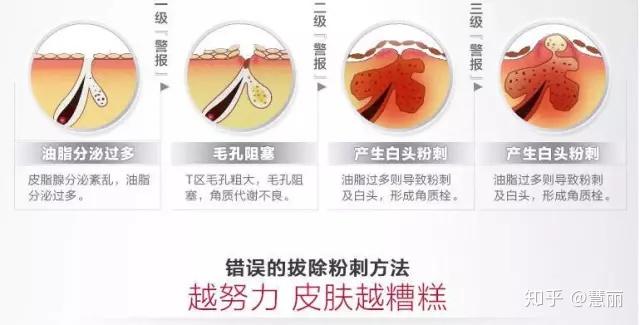 你脸上为什么会长白头粉刺用什么方法可以去除