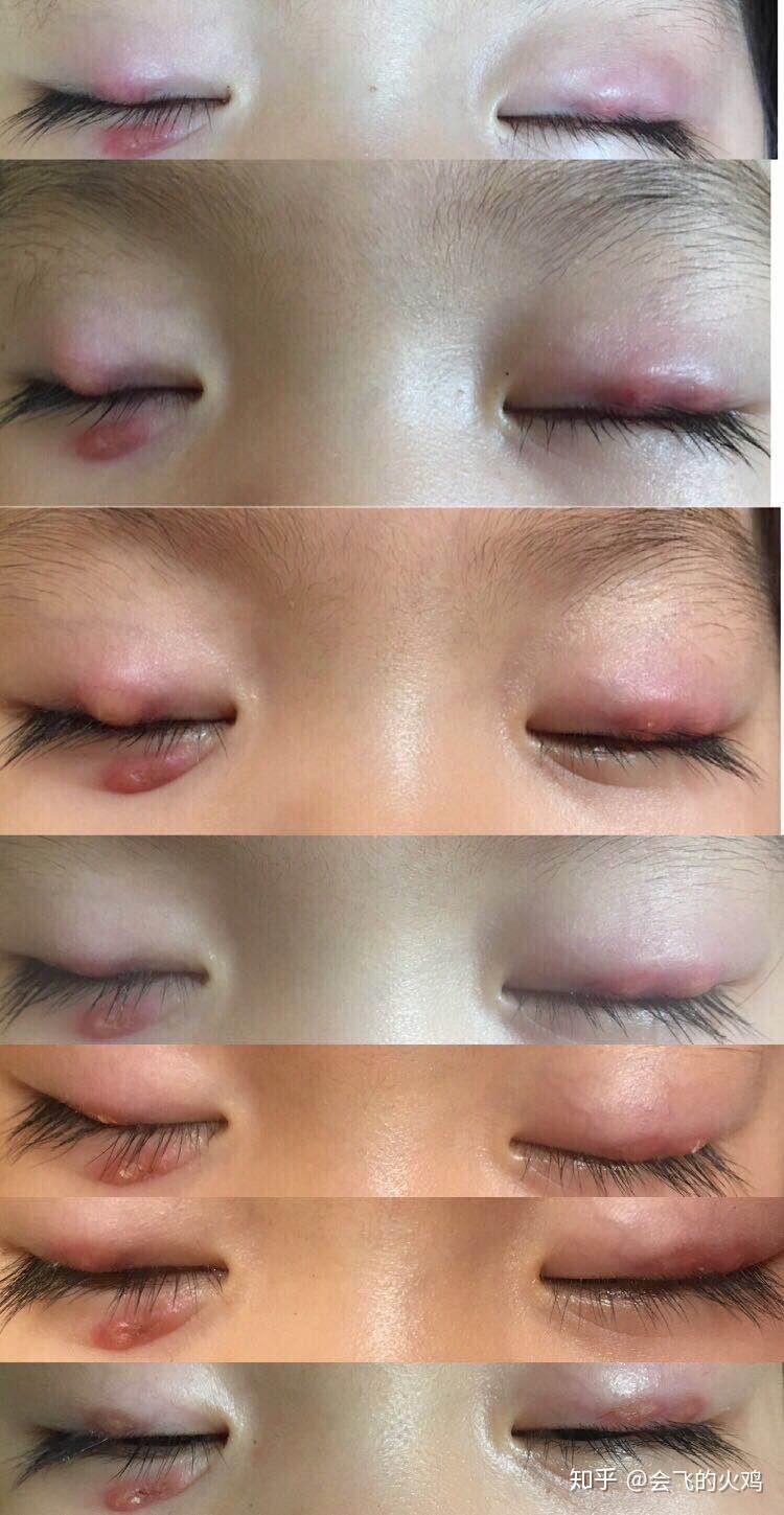 2岁大的女孩,从1岁左右开始霰粒肿不断的发作,试过各种医院,一直无法