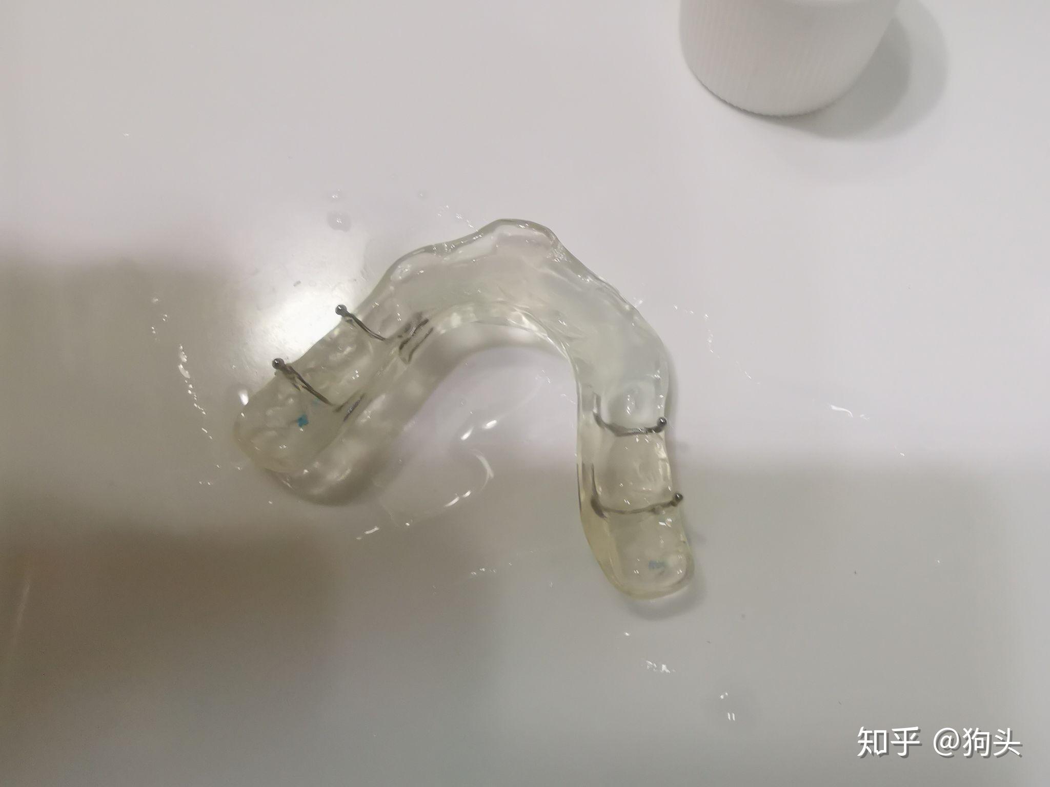 门牙根管带冠补牙关节弹响深覆合二次矫正2020年记事发现牙问题后的