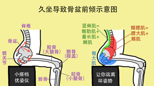 骨盆前倾和后倾傻傻分不清 一文搞懂这俩体态问题的异同 知乎