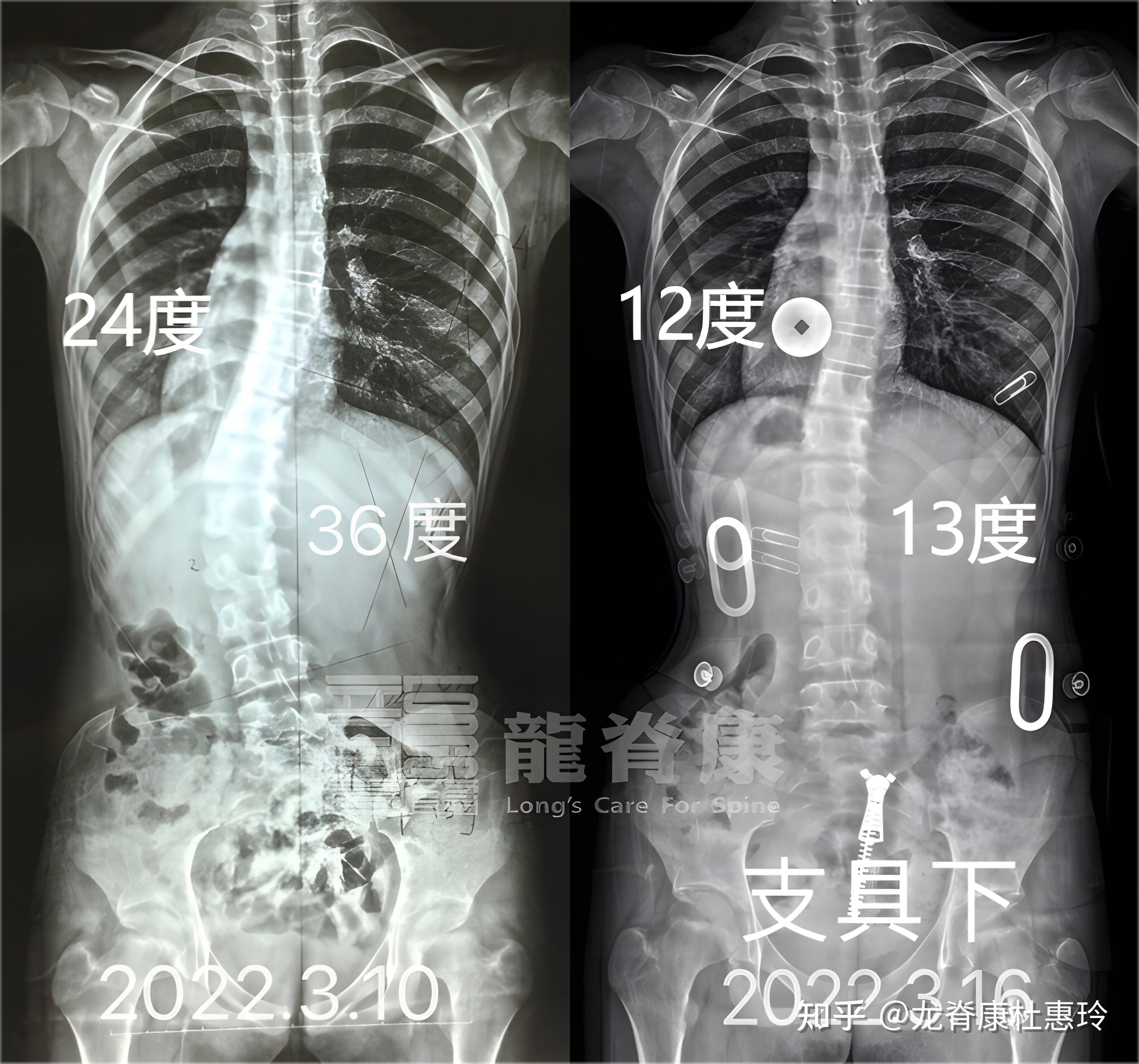女孩脊柱侧弯36度,治疗1周后,体表中线回归正常 - 知乎
