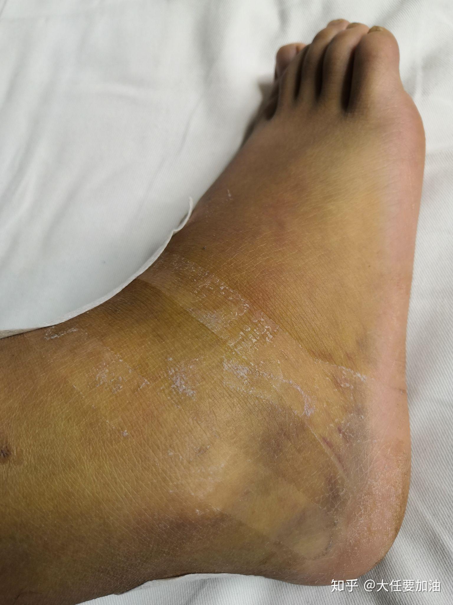 脚踝右侧胫骨远端骨折康复历程
