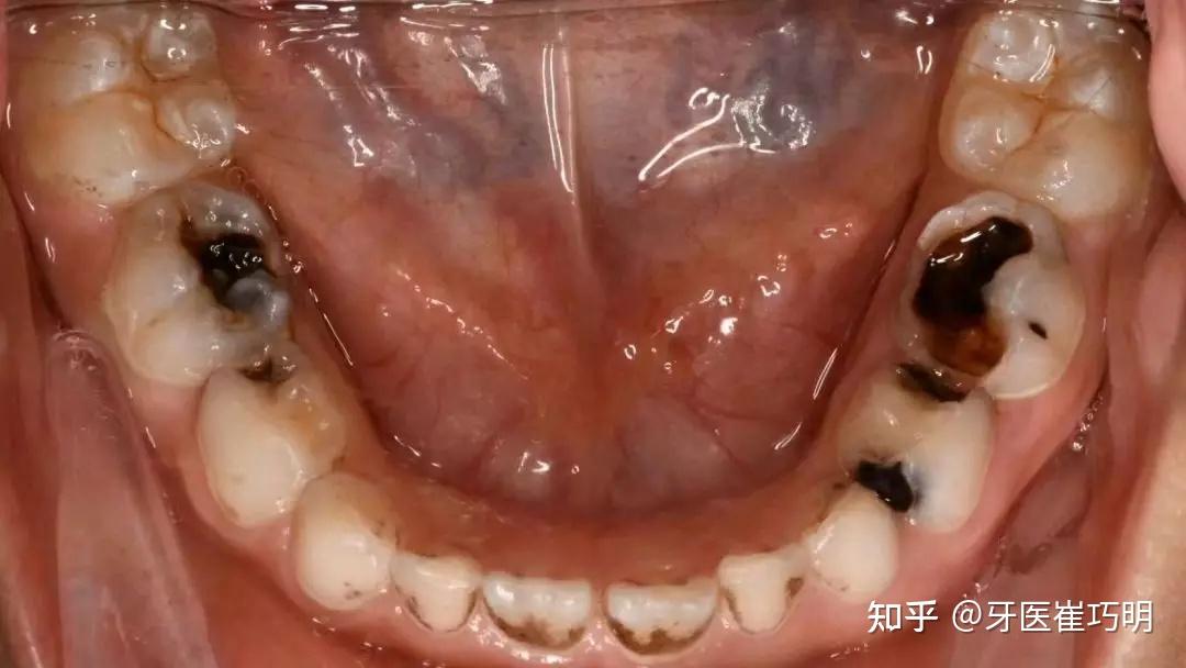 色素沉积:仅在牙齿表面形成污垢,保护层还没有被破坏.