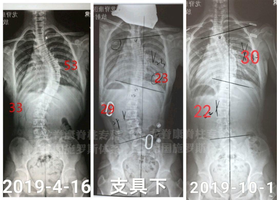 经典问答:脊柱侧弯24问(很全的问题汇总,快收藏!