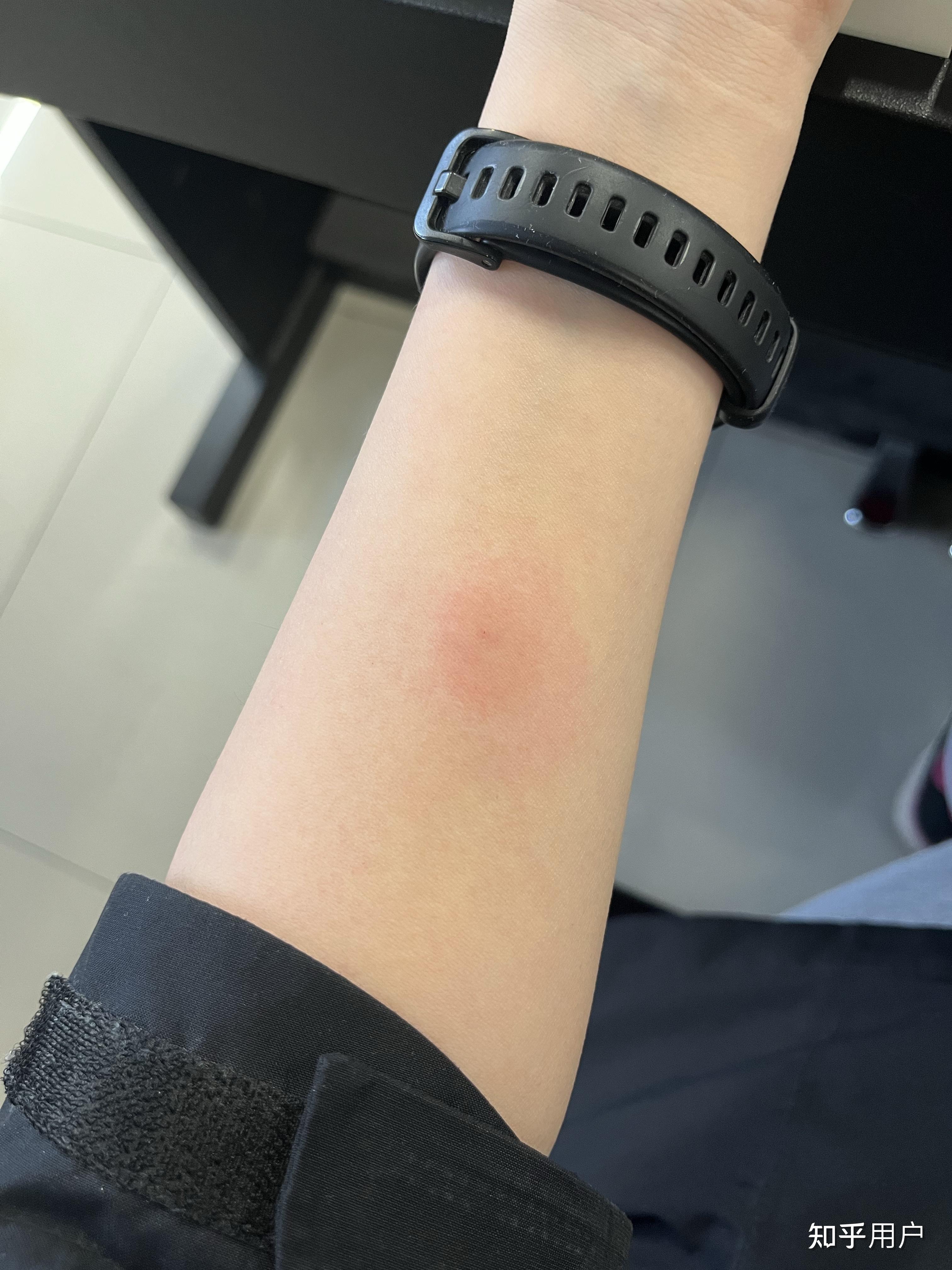 ppd皮试后这个样子怎么办? - 知乎