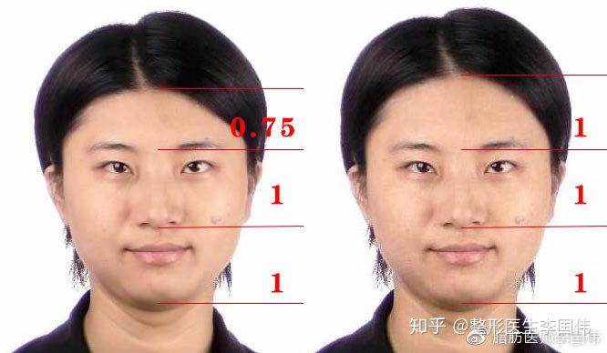 额头凹陷区分,改善涉及的美学,填充物如何选择 - 知乎