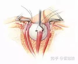 眼球摘除手术 作为眼科医生最无奈的手术之一 它是如何进行的 知乎