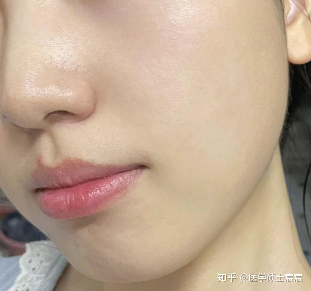 【去法令纹必看】法令纹怎么消除?有什么去法令纹最有效的方法?【医学生分享】28天就能去法令纹的4个步骤,get无痕细腻好皮肤!