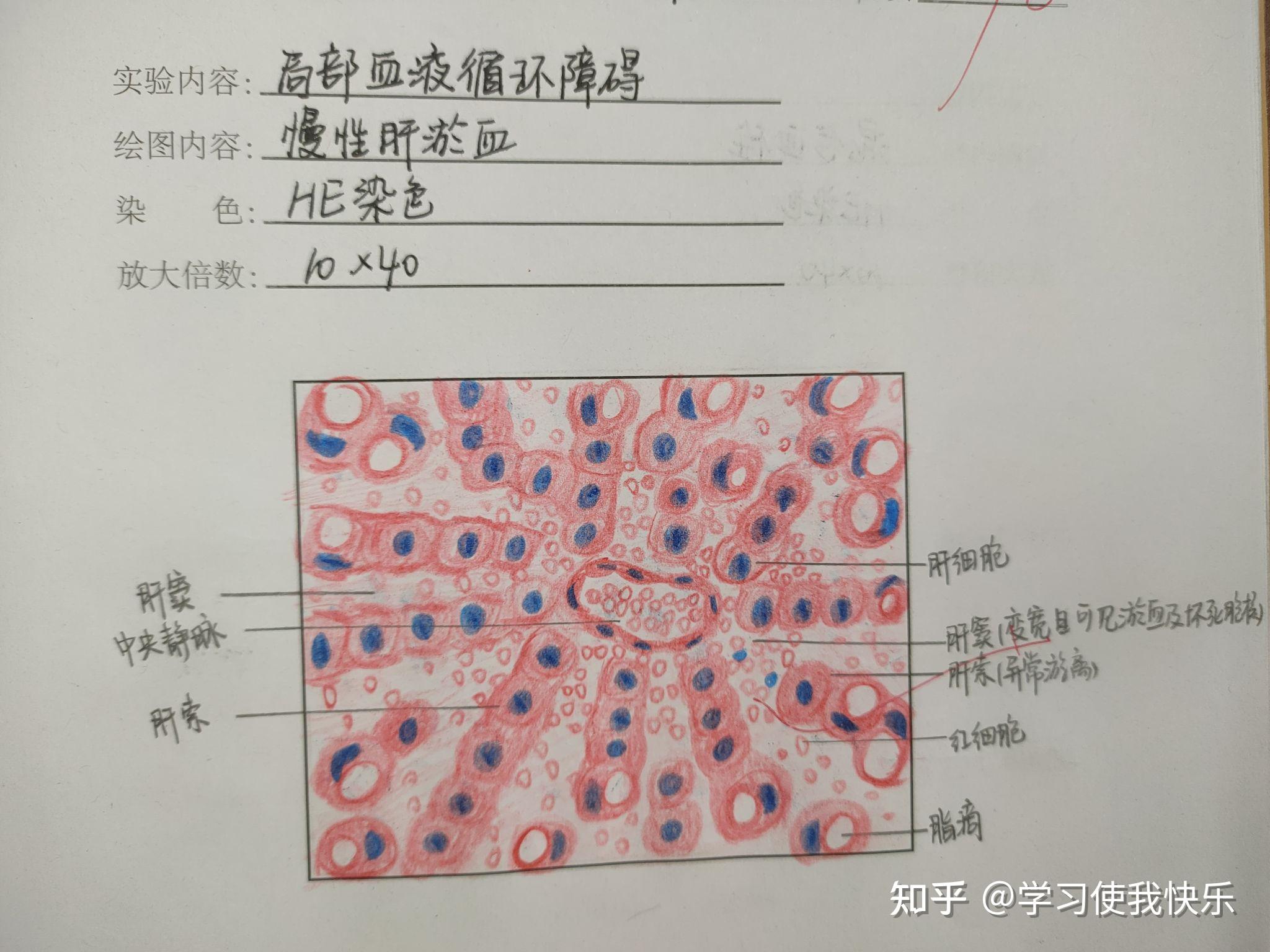 病理血栓红蓝铅笔绘图图片