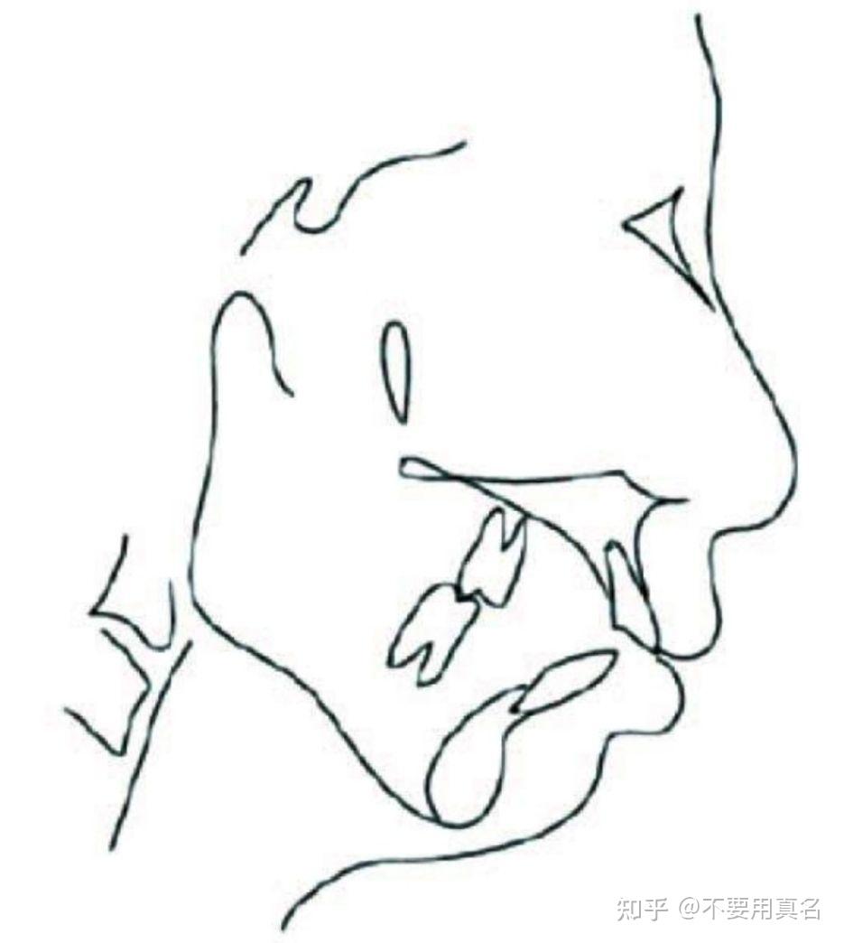 但是大多数的下颌后缩错颌生长方向缺少逆时针旋转,主要原因是下颌升