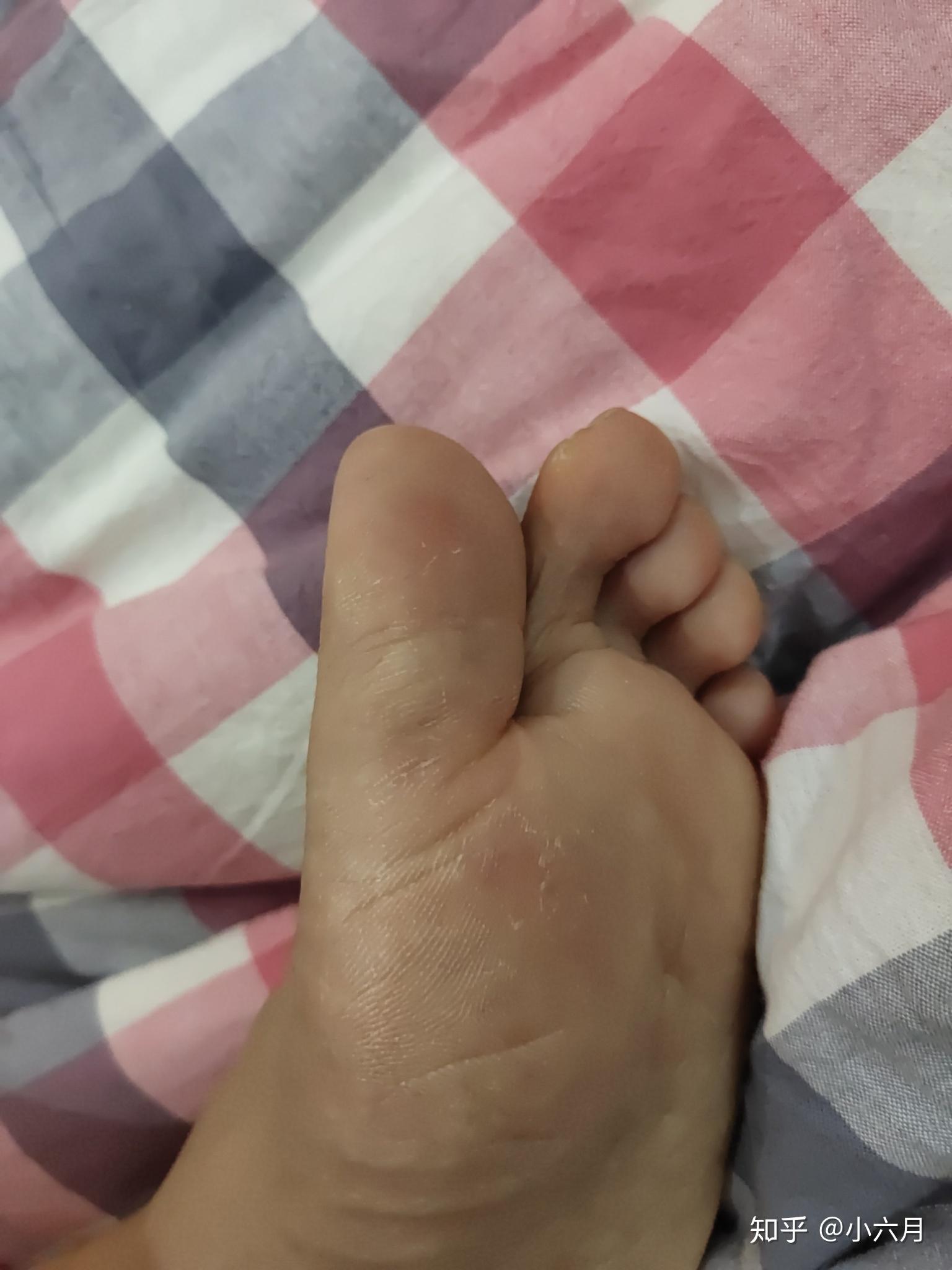 关于跖疣用蒜敷了十三天的结果带图
