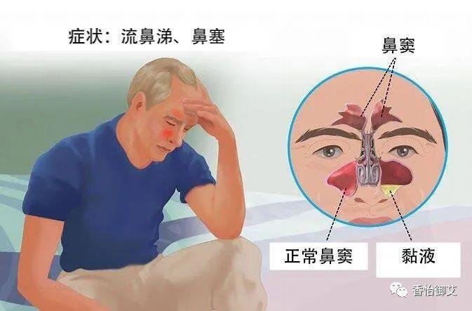 鼻窦炎艾灸效果好,艾灸治疗鼻窦炎效果很理想!鼻窦炎艾灸穴位 - 知乎