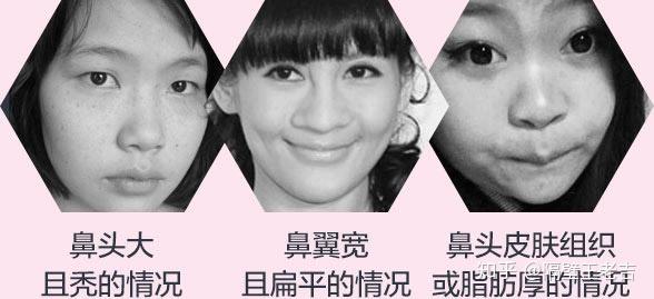 什么办法能让鼻子缩小 v2-d55cf50d6fc6e9660b894a7816ec77ac_r.jpg