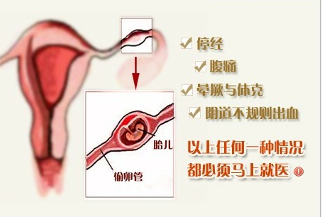 宫外孕是怎么引起的 宫外孕的症状及诊断 知乎