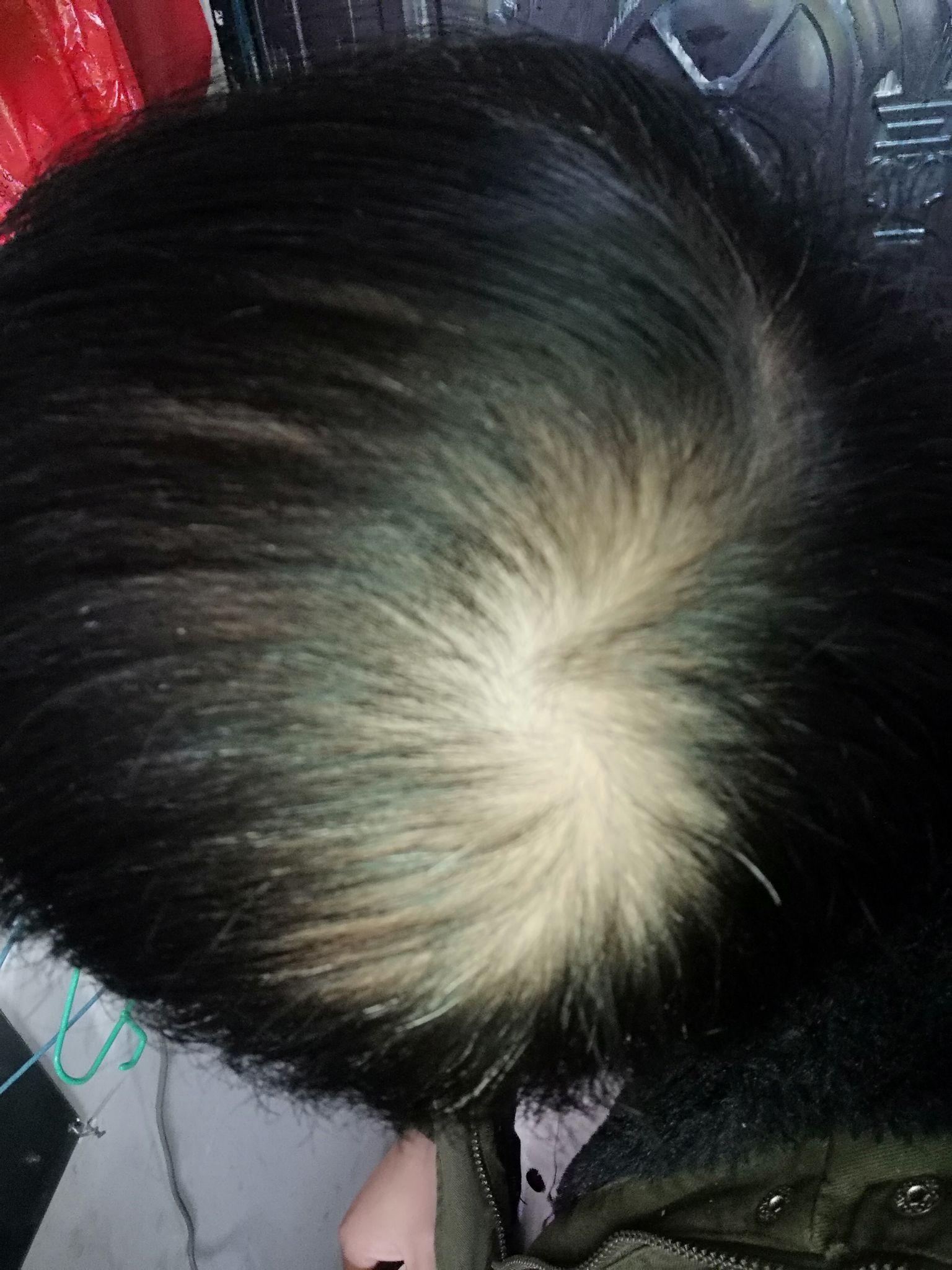 男性,26岁,头顶和后脑勺头发稀少,怎么办,以前贼帅 头发又多 当然