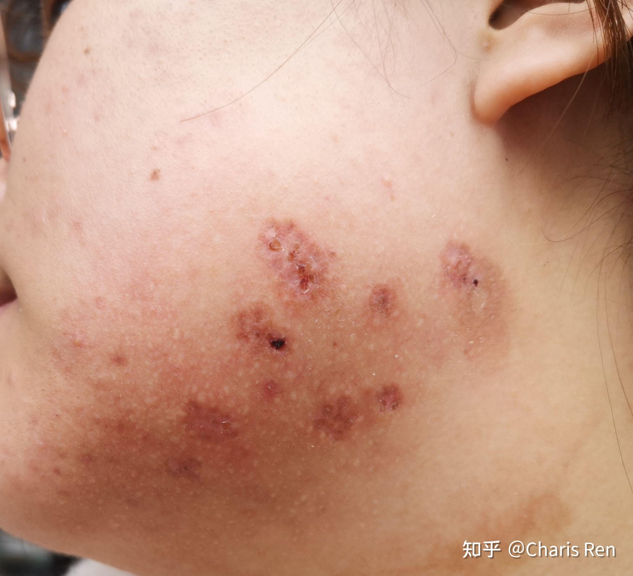 下颌瘢痕疙瘩手术恢复ing…(不广单纯记录 )