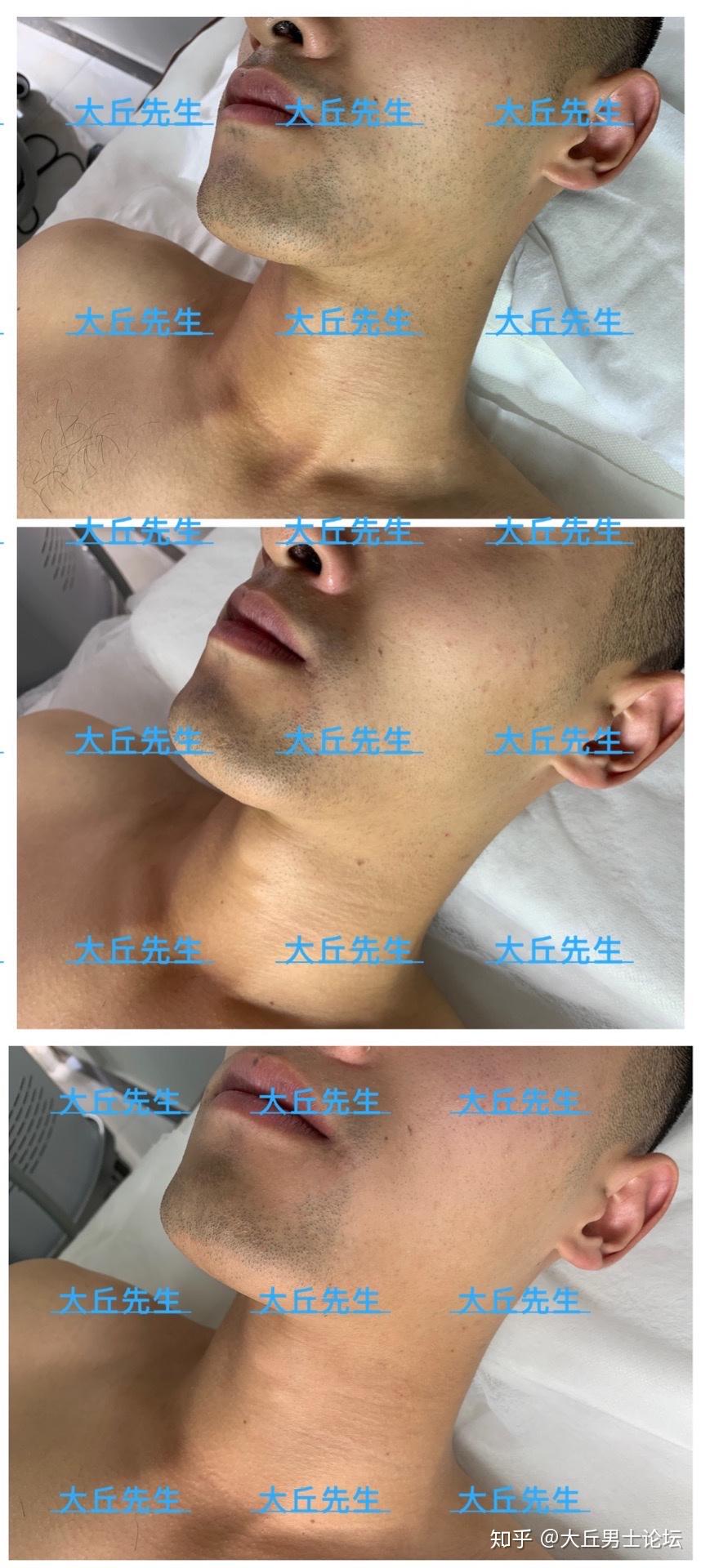 男士脸部胡须激光脱毛效果如何? - 知乎