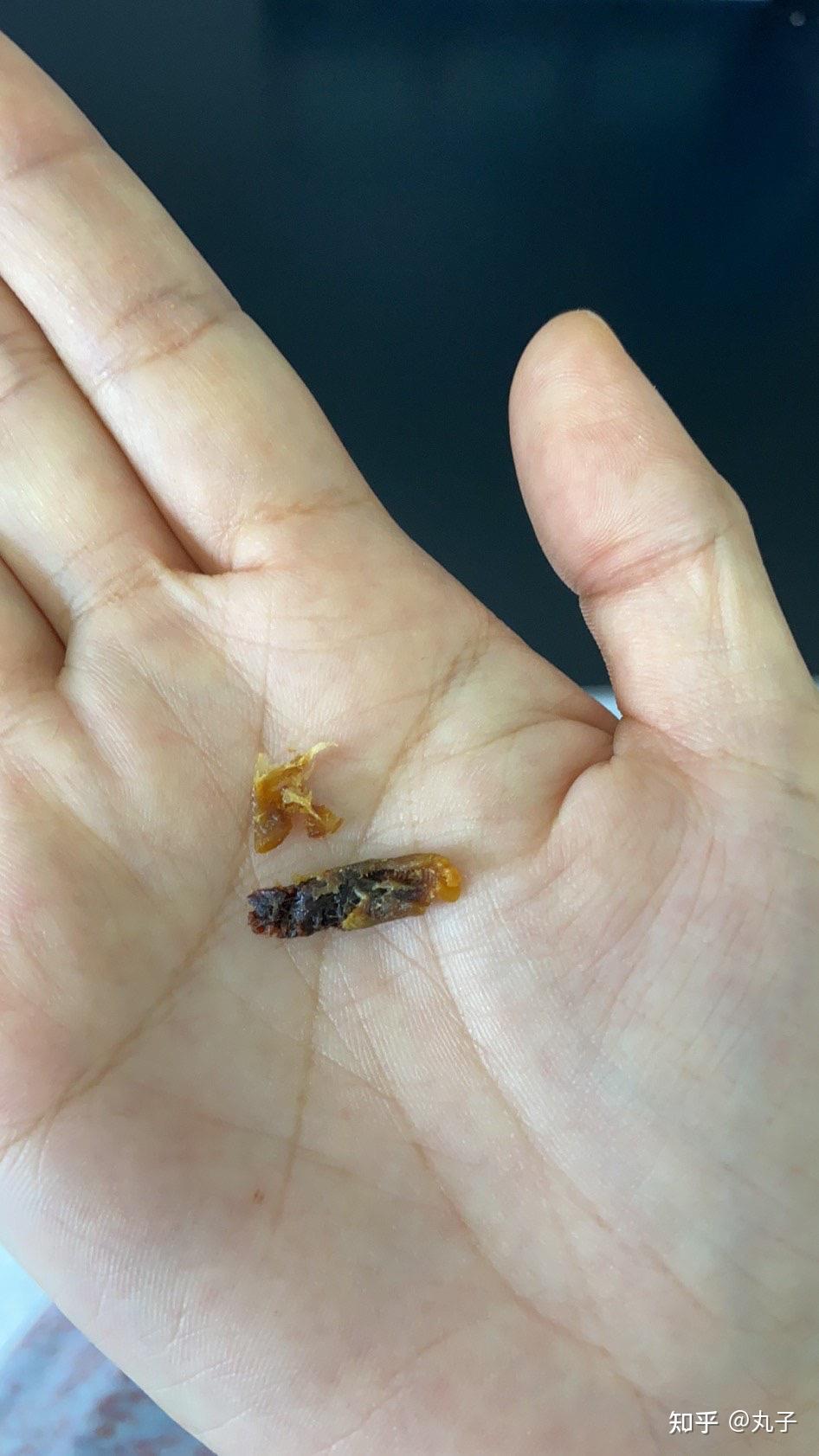 耳屎最大能有多大? - 知乎