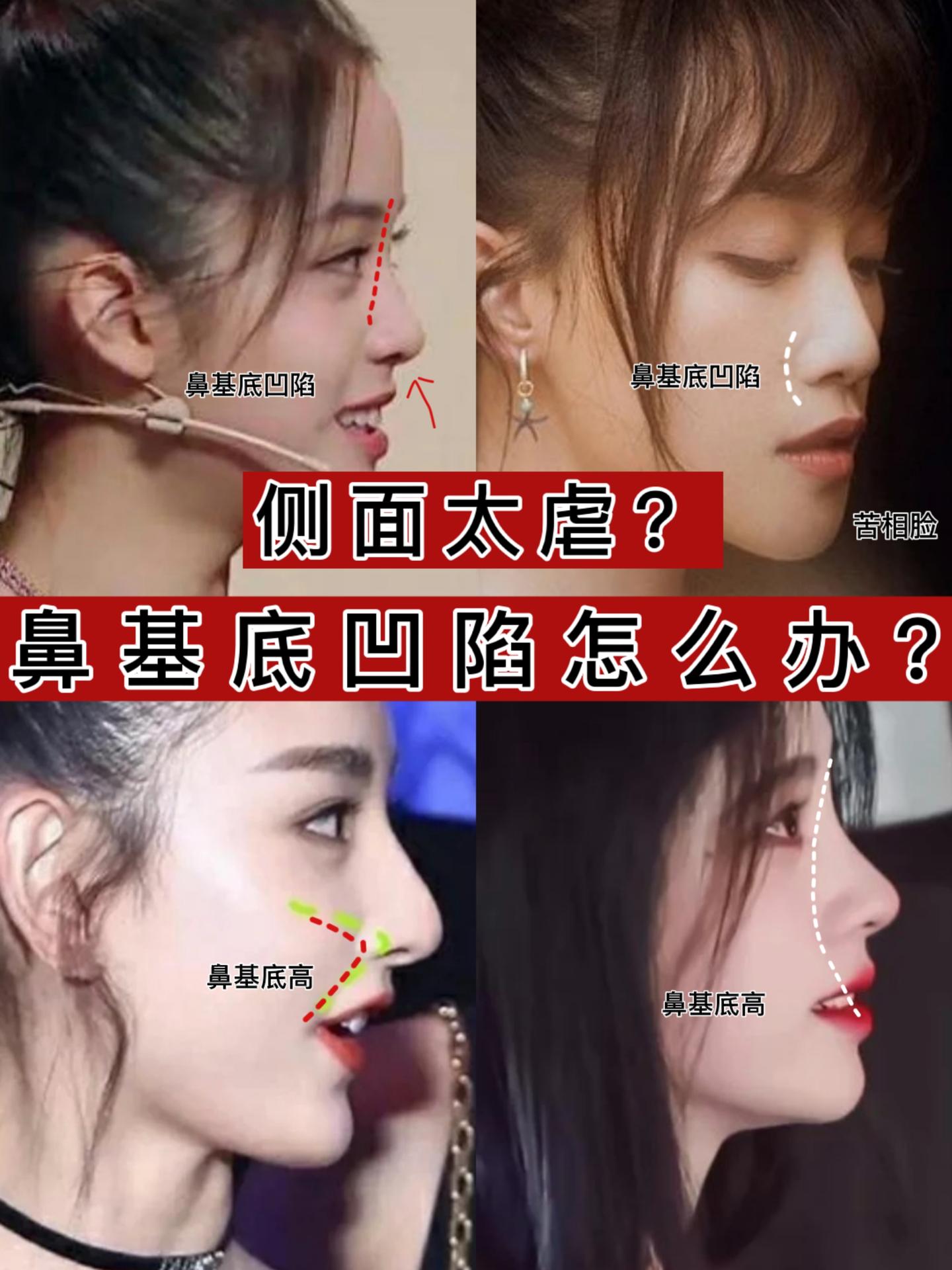 侧脸太虐 快来测测是不是鼻基底凹陷 知乎