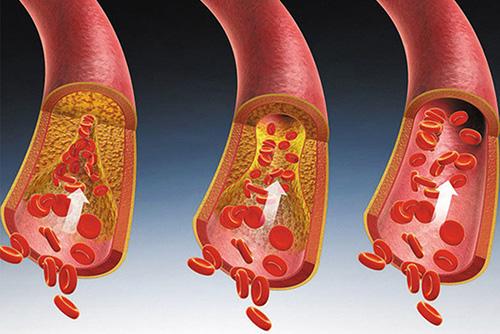高血脂患者的福音蜂产品治疗高脂血症的偏方