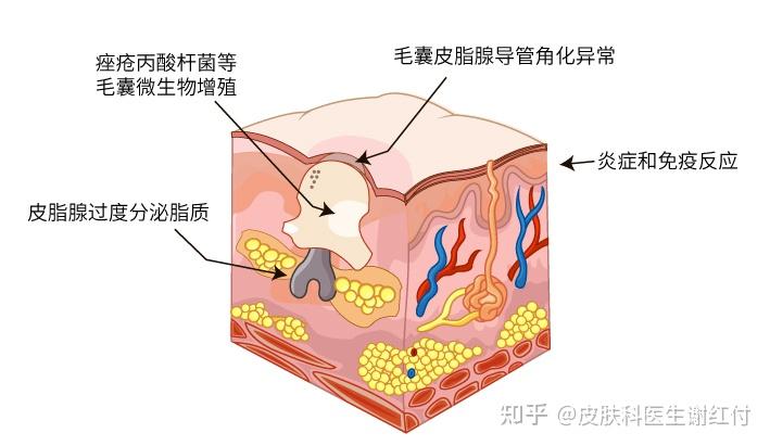 毛囊皮脂腺导管角化异常3 痤疮丙酸杆菌等毛囊微生物增殖4