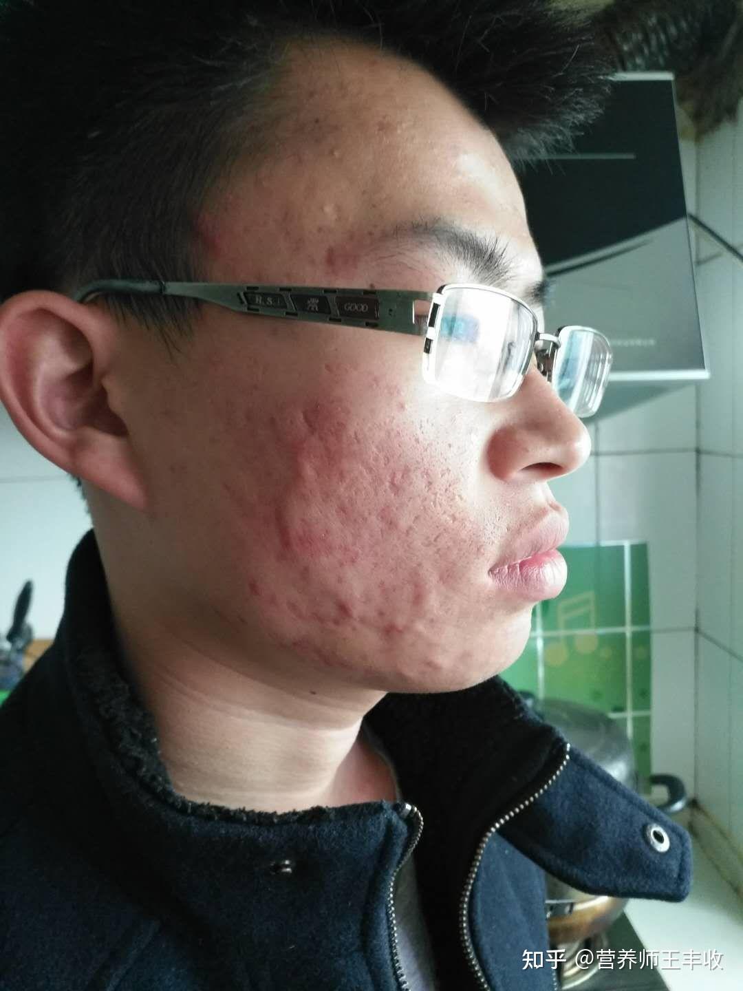 脸油到底是什么原因导致的