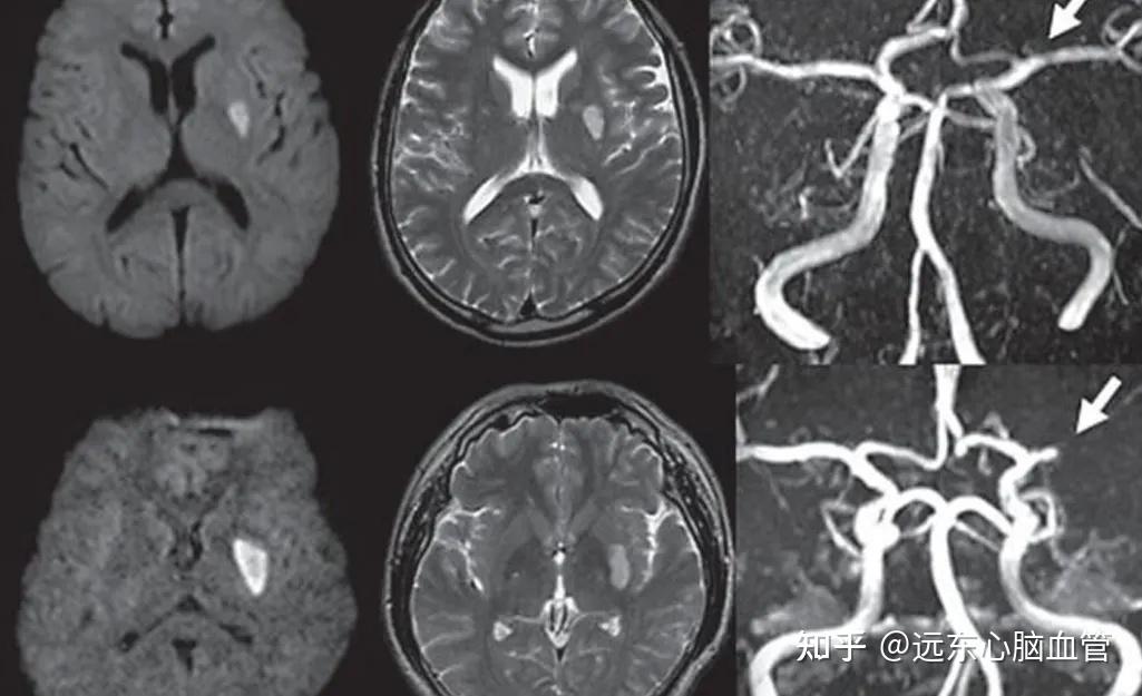 "腔梗"过,经常要疏通血管吗? - 知乎
