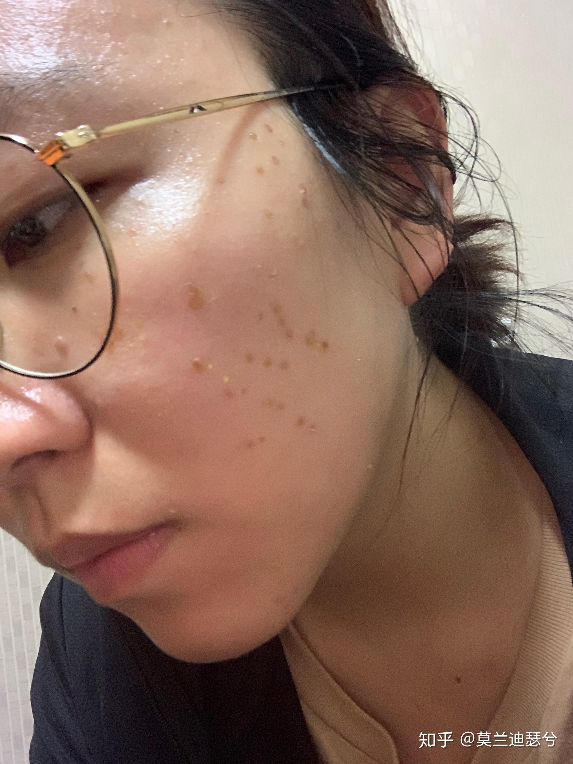 面部扁平疣脉冲激光治疗记录