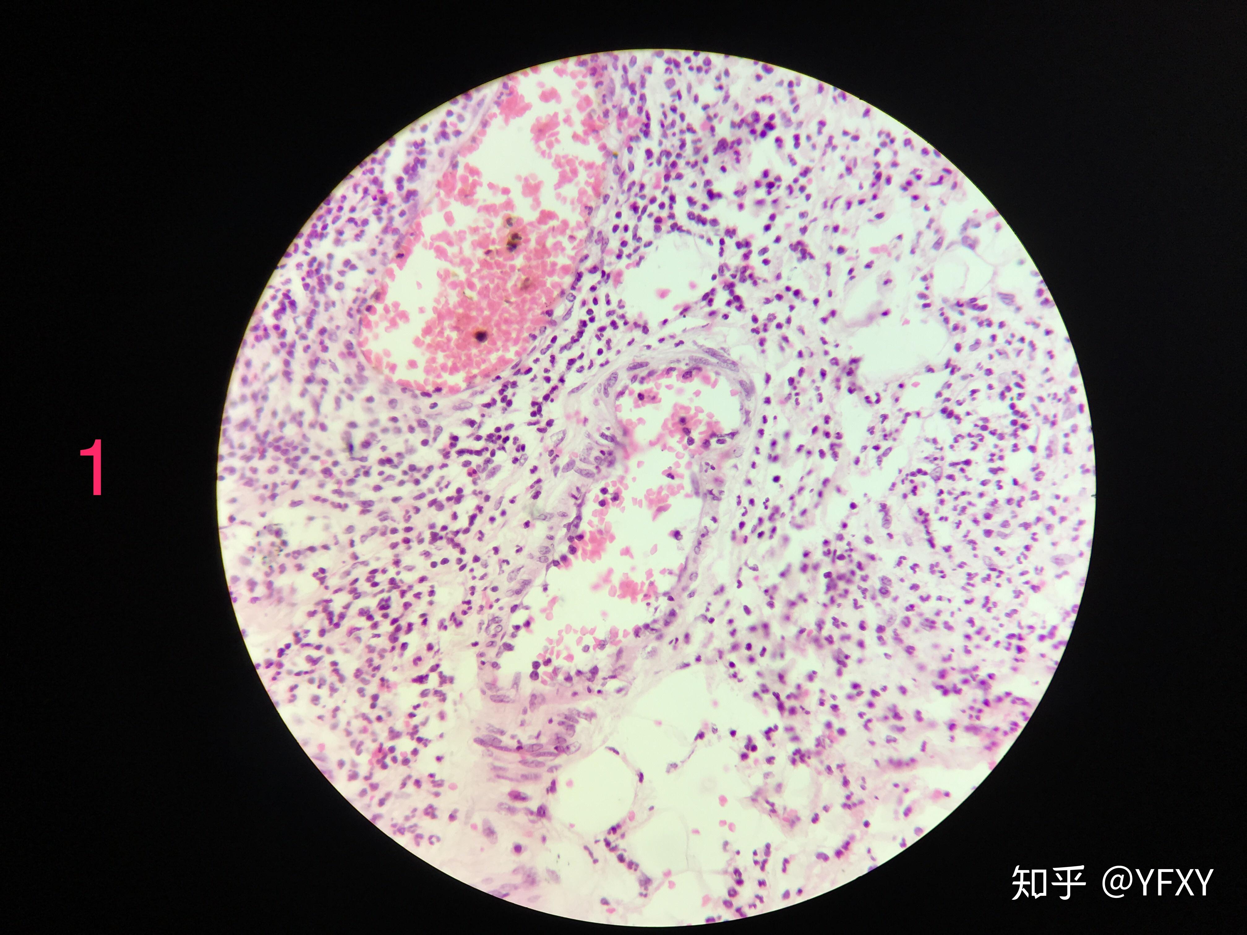 肺炎链球菌红蓝铅笔图片