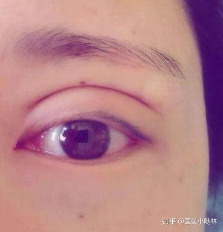 双眼皮肉条感是怎么回事