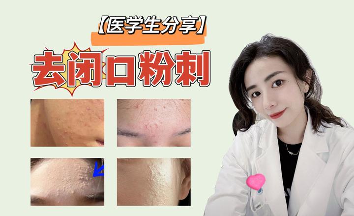 【闭口粉刺必看】闭口粉刺怎么解决?【医学生分享】7天就能去闭口粉刺的4个步骤,再难搞的闭口粉刺都能轻松解决!! - 知乎