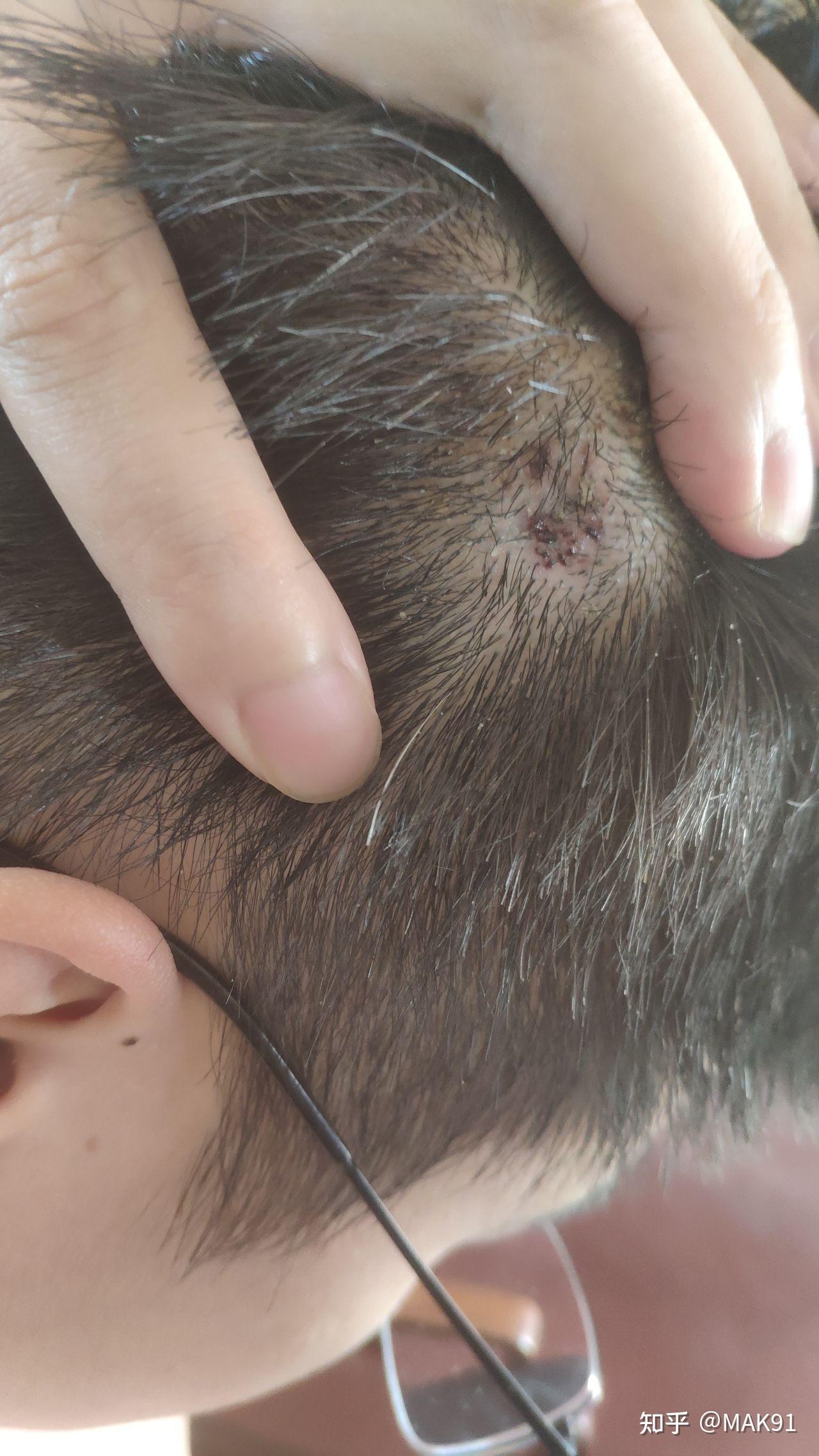 头皮上长了一个红色的小肉球不疼不痒的问一下是啥? - 知乎