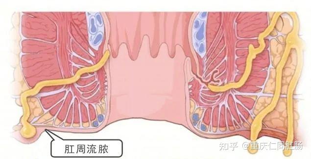 拉屎菊花痛千萬別錯怪痔瘡重慶肛腸醫院哪家好