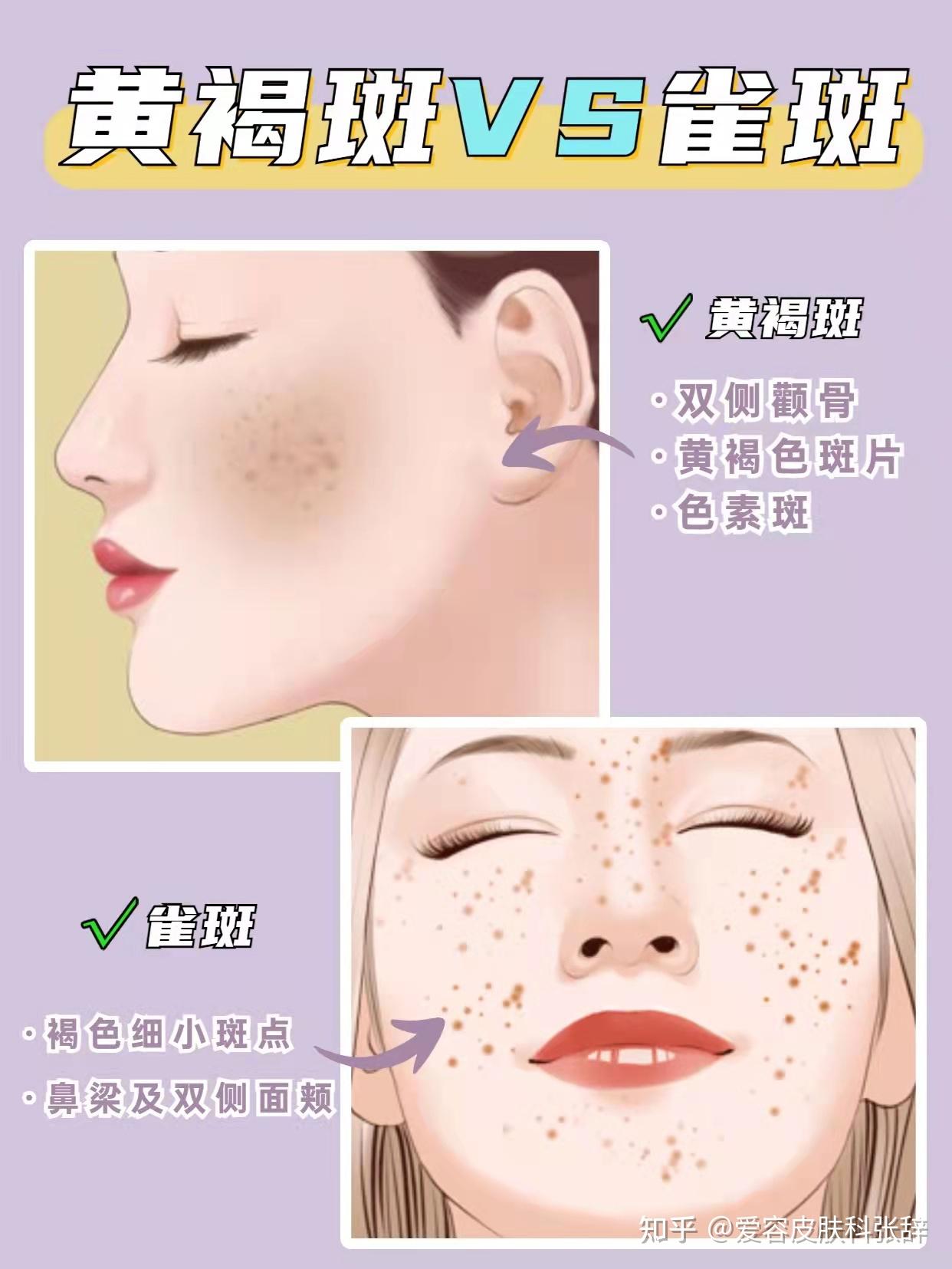 脸上长斑是身体哪个部位出了问题黄褐斑怎么去除效果好