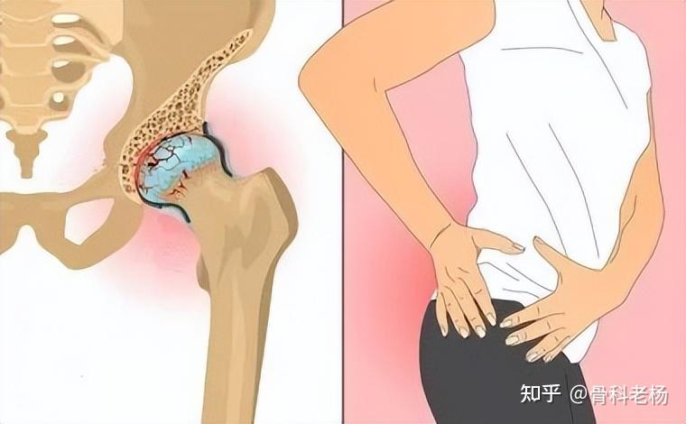 热水泡脚有助于股骨头坏死治疗