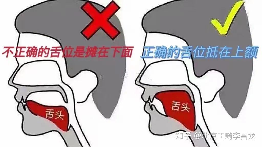 北京牙齿矫正丨舌头位置放错,影响那么大?快看看你的舌头放对位置了吗 - 知乎