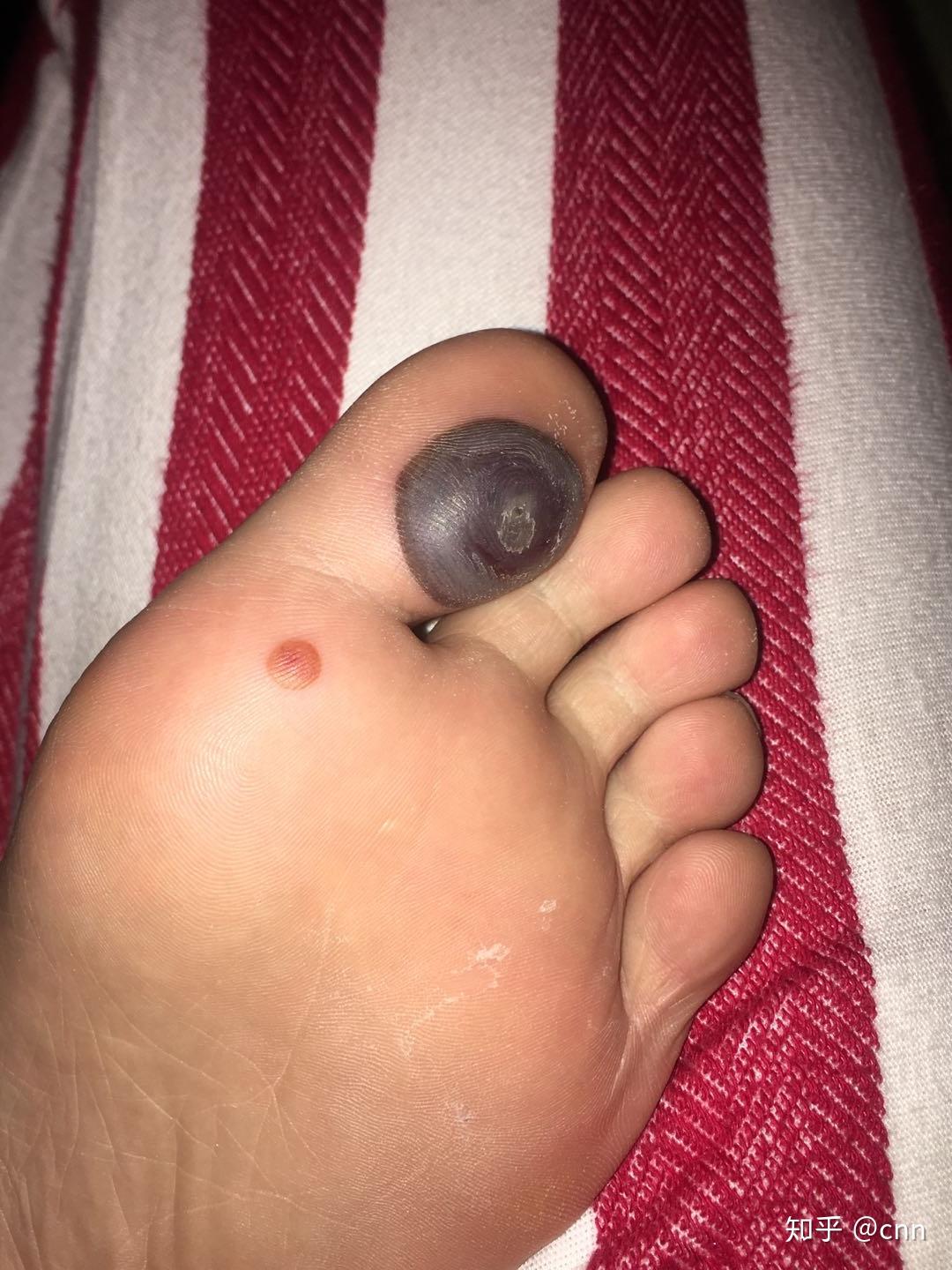 两个月治愈跖疣报告