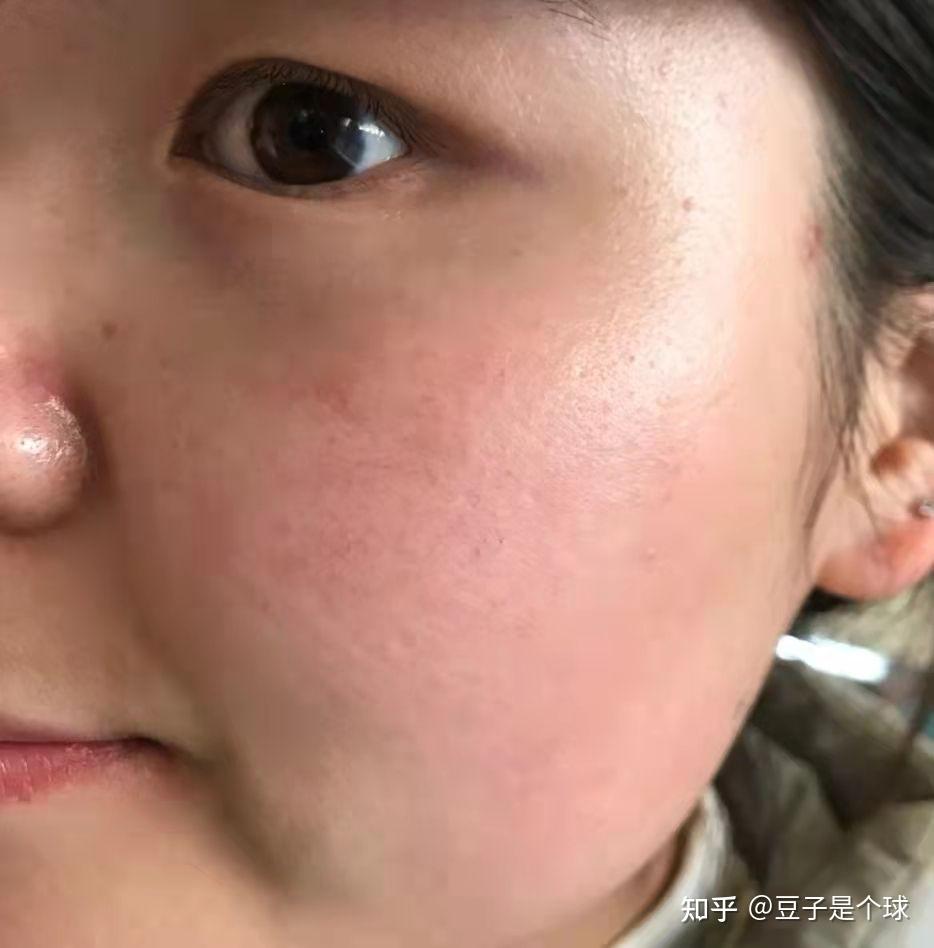 敏感肌脸泛红的你们用过超好用的护肤品是什么? - 知乎