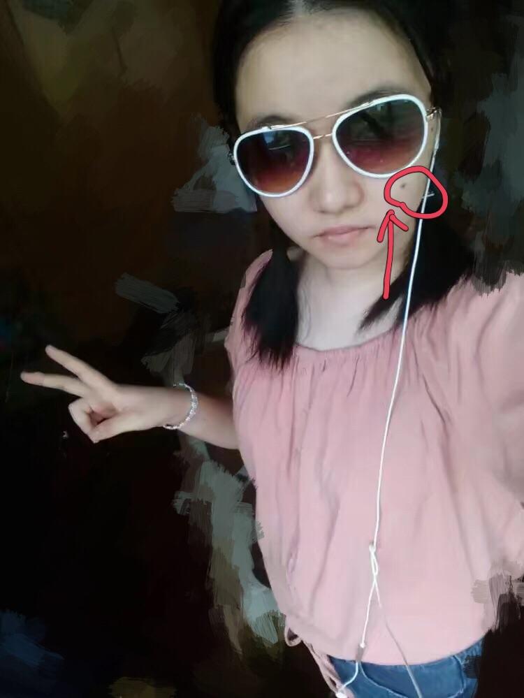 手术切痣是一种怎样的体验?