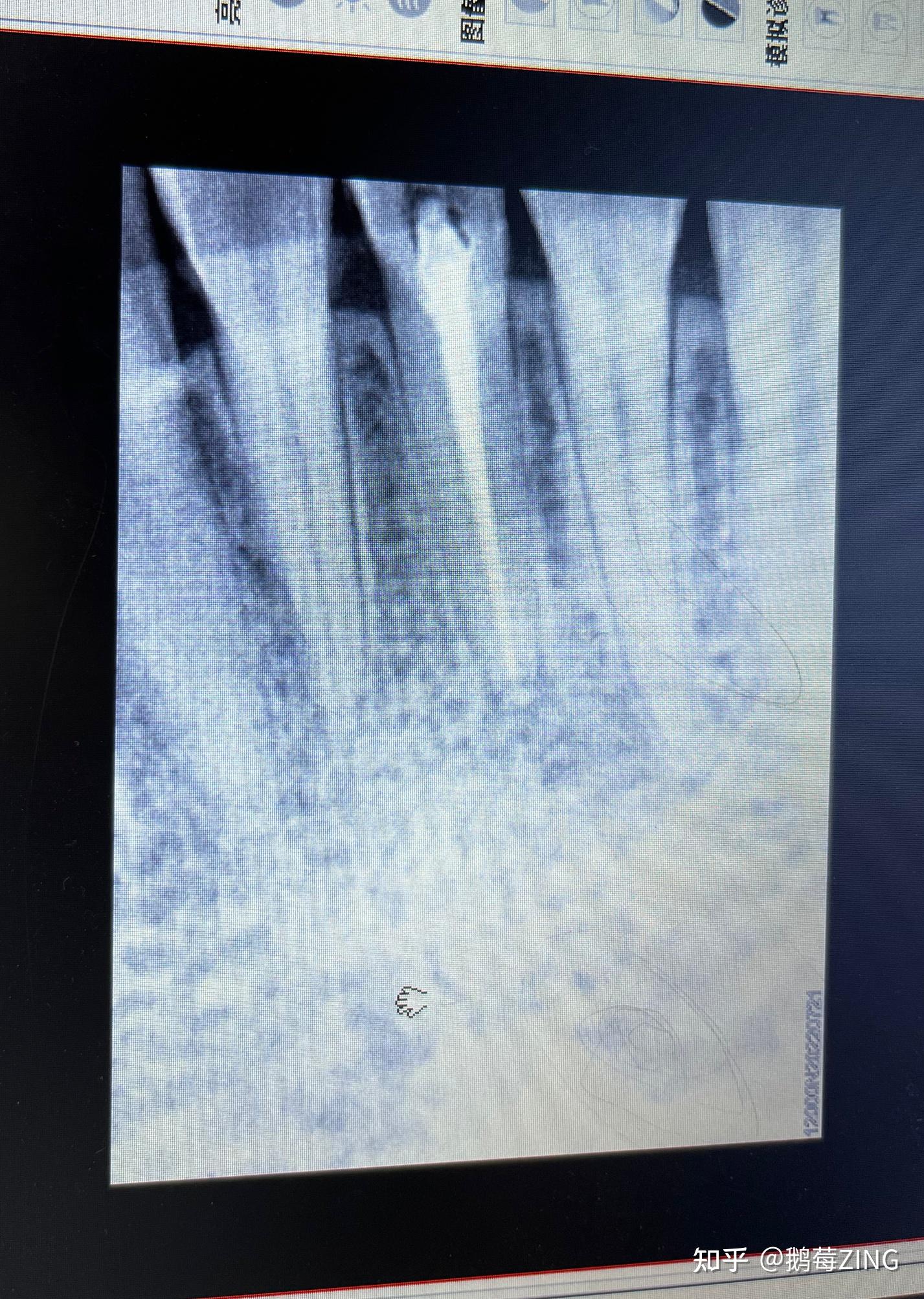 记录一次根尖囊肿之前期保守根管治疗